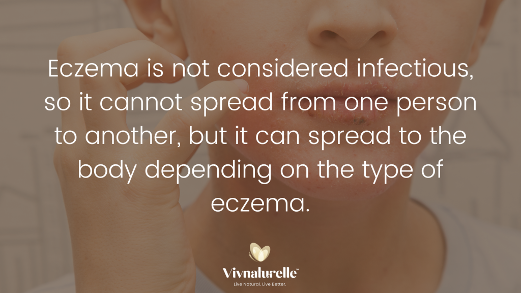 Eczema is not infectious